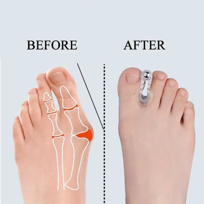Bunion Toe Corrector 2pcs Foot SupportX2